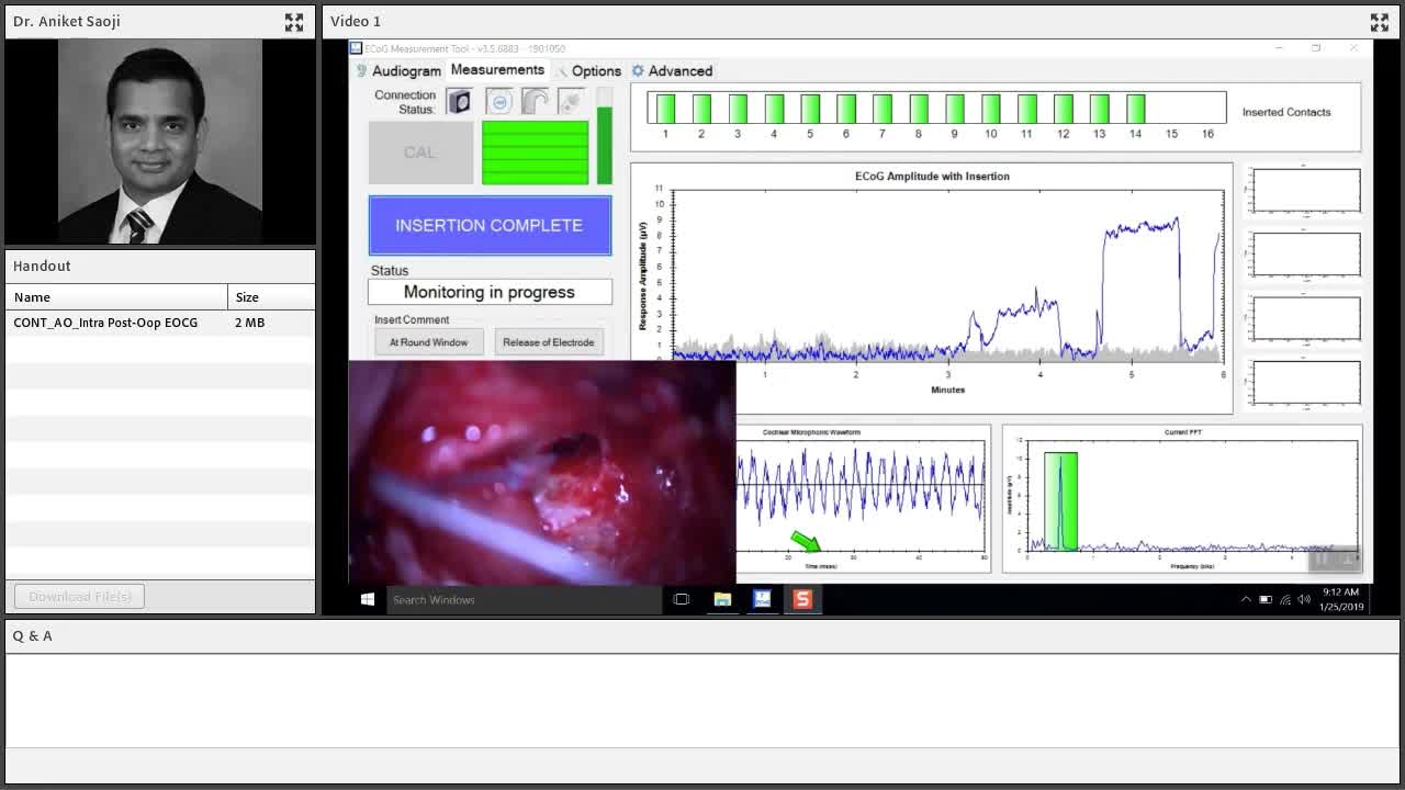 Screenshot of video showing surgical screen during cochlear implant